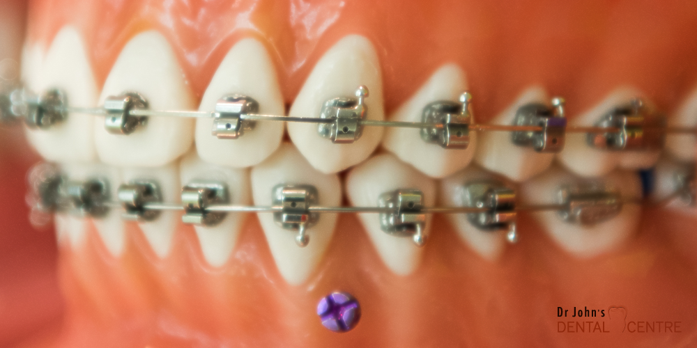 Orthodontics at Dr John's Dental Centre Trivandrum