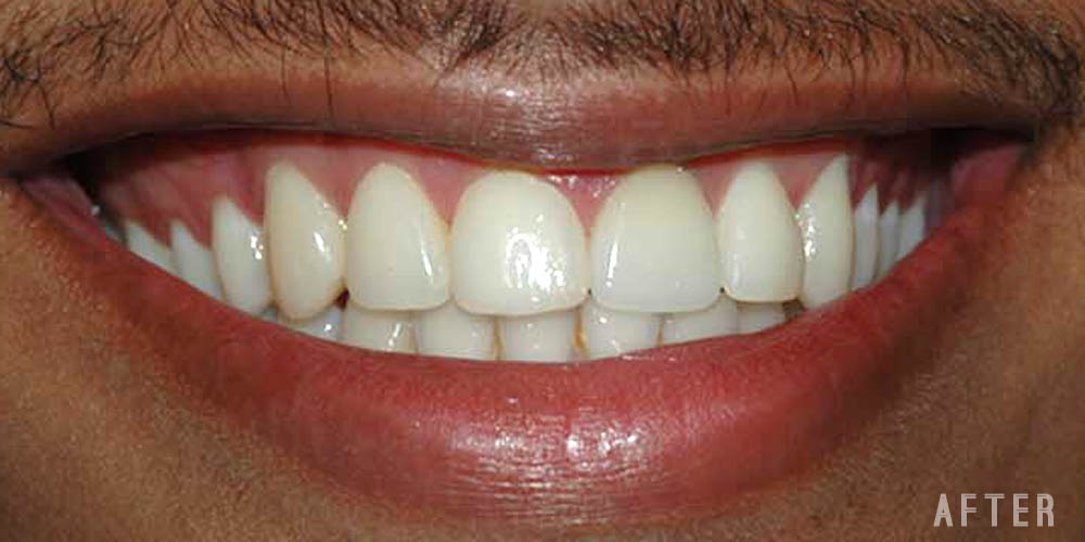 Dr-Johns-Dentistry-Services-Smile-correction